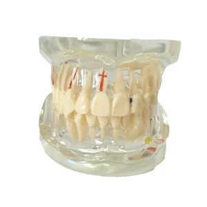 Model dentar patologic C4