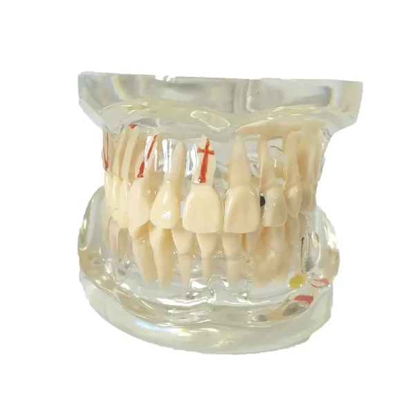 Model dentar patologic C4