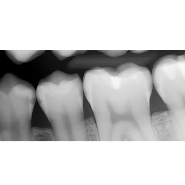Senzor intraoral radiologic Digisens HD - imagine 3
