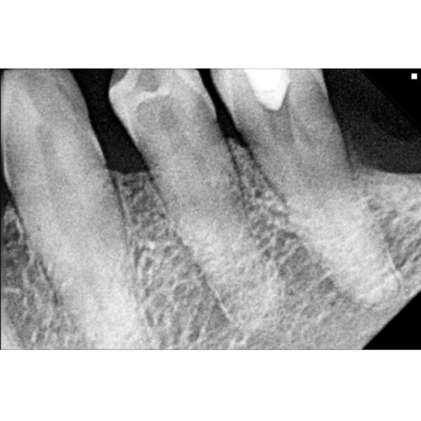 Senzor intraoral digital radiologic Rayin - imagine 5