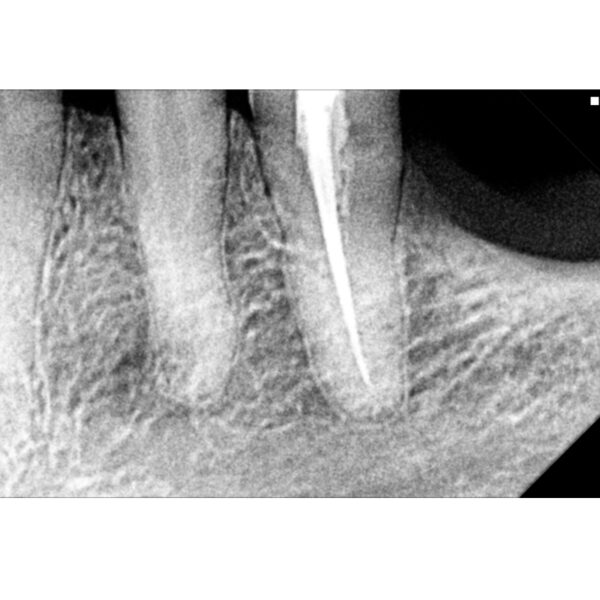 Senzor intraoral digital radiologic Rayin - imagine 4