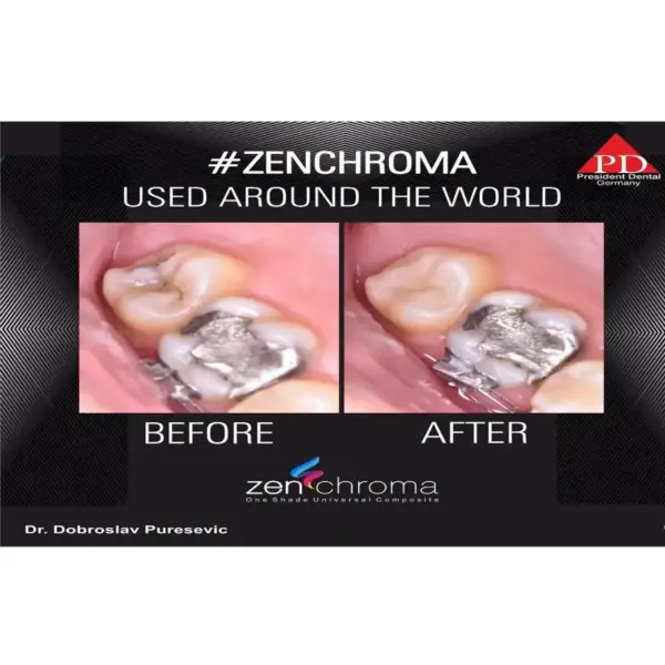 Zenchroma compozit universal Refill 4g President - imagine 3