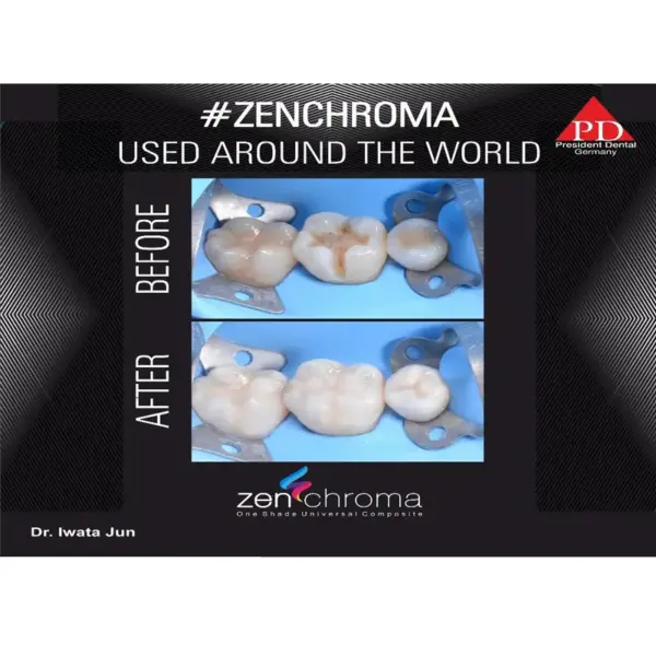 Zenchroma compozit universal Refill 4g President - imagine 5