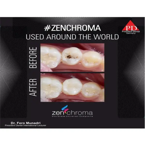 Zenchroma compozit universal Refill 4g President - imagine 2